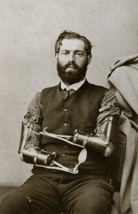 Bionic prosthetic hands